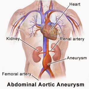 aortic-aneurysm-diagnosed