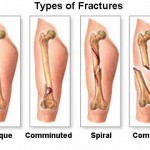 type-of-fractures