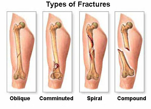 type-of-fractures
